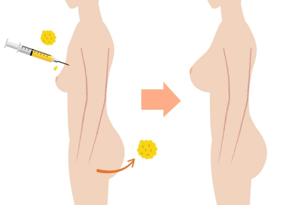 Nâng ngực bằng mỡ tự thân là một trong các phương pháp nâng ngực an toàn