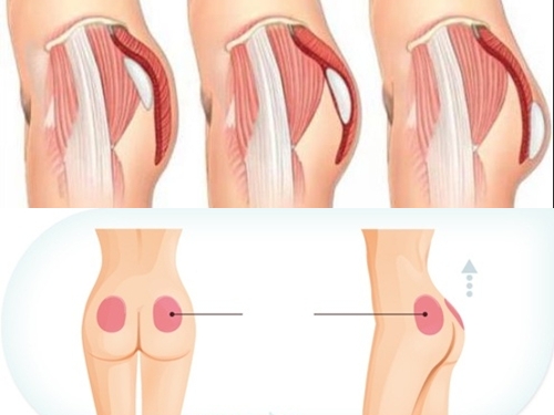 Phẫu thuật nâng mông tăng thêm nét quyến rũ và ấn tượng mạnh hơn đối với phái mạnh