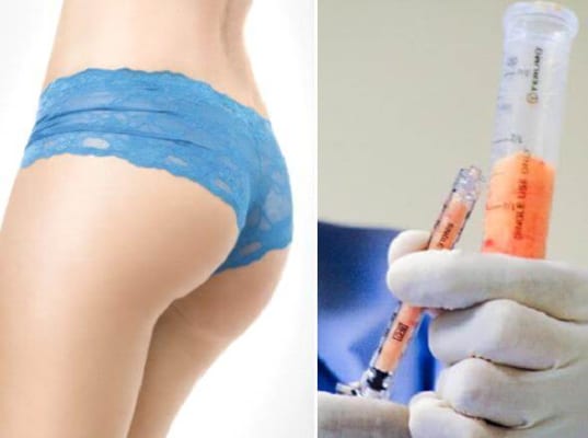 Kỹ thuật nâng mông bằng cấy mỡ tự thân không gây ra chảy máu và không để lại sẹo