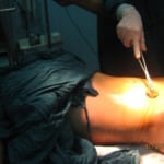 [ Phẫu thuật thực hành] Mổ cắt ruột thừa