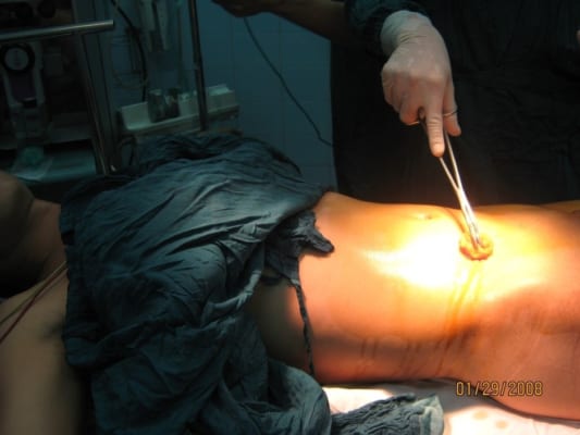 Drtien.com- Bài giảng phẫu thuật thực hành mổ cắt ruột thừa