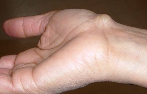 U bao hoạt dịch cổ tay có thể do bong gân hoặc tiểu sử về chấn thương cổ tay