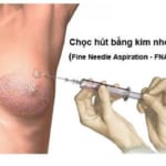 3 cách điều trị u nang tuyến vú phổ biến hiện nay