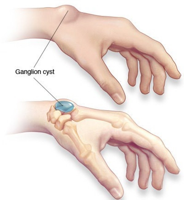 Sau mổ u bao hoạt dịch cổ tay người bệnh có vận động bình thường?