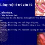 Bài giảng bệnh lồng ruột cấp ở trẻ nhũ nhi