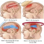 Bài giảng chấn thương vết thương sọ não