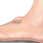 U bao hoạt dịch mu bàn chân: Dấu hiệu và cách chữa trị