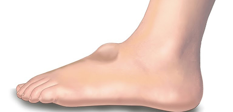 Những nguyên nhân nào dẫn đến u bao hoạt dịch mu bàn chân?