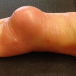 U bao hoạt dịch ngón tay: Dấu hiệu và cách chữa trị