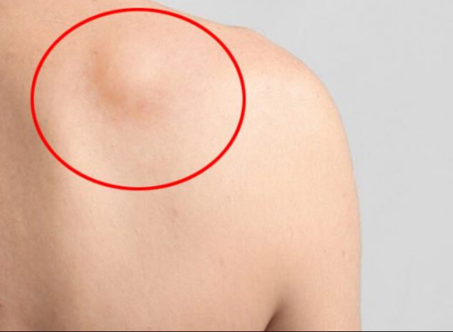 Khối u cứng dưới da ở phía sau lưng thường là u mỡ hoặc u xơ lành tính.