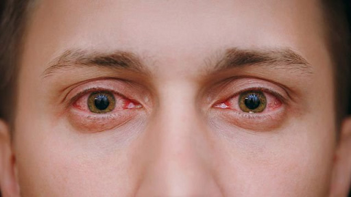 U mỡ kết mạc mắt không gây nguy hiểm đến tính mạng nhưng ảnh hưởng đến tính thẩm mỹ.