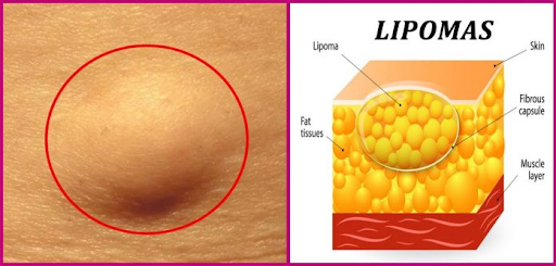 U mỡ là một khối u do sự tích tụ của các tế bào mỡ tạo thành ở phần dưới da và cơ.