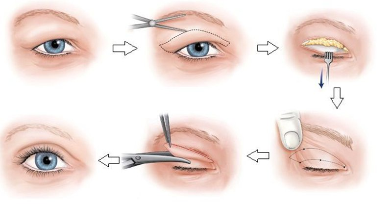 Quy trình cắt mí mắt an toàn tại Dr. Tiến 