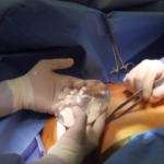 Quy trình phẫu thuật nâng ngực chuẩn Bộ Y Tế gồm bước nào?