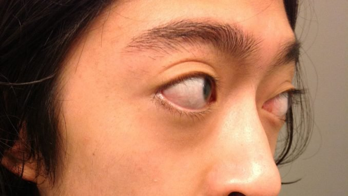 Bướu giáp gây ra các biến chứng về mắt