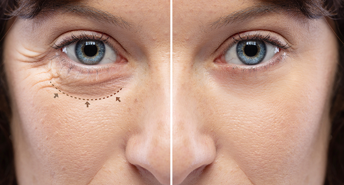 Đôi mắt phục hồi hoàn toàn sau phẫu thuật cắt mí mắt (ảnh phải)